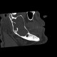 Keratocyst of mandible: CT - Computed tomography